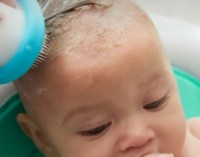 Набор для ухода за малышом Frida DermaFrida FlakeFixer (FRI14) фото №9 — интернет-магазин Desire.md